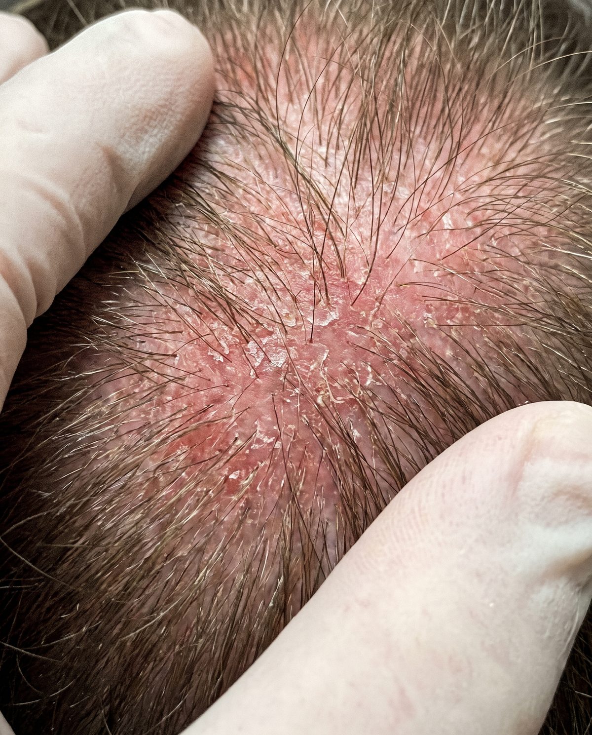 Close-up of a scalp showing redness and fine scaling