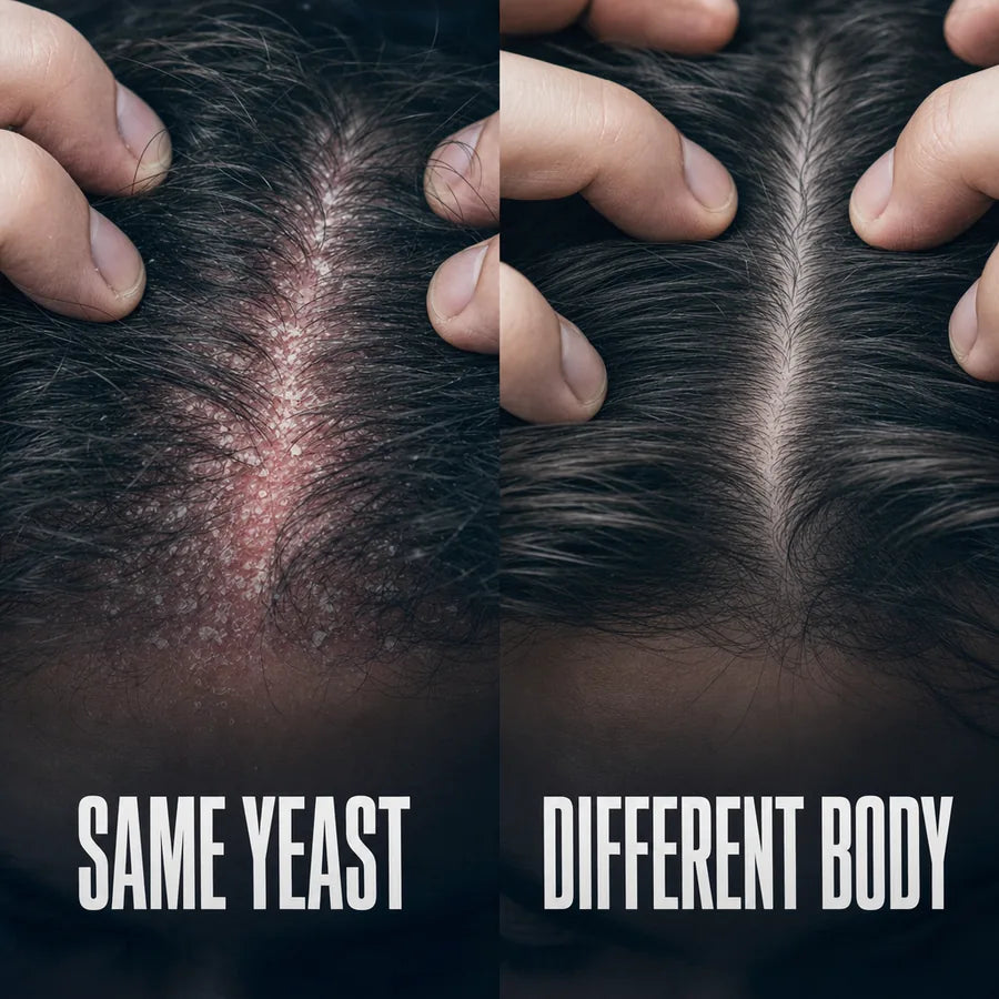 Two scalps, same yeast, different response