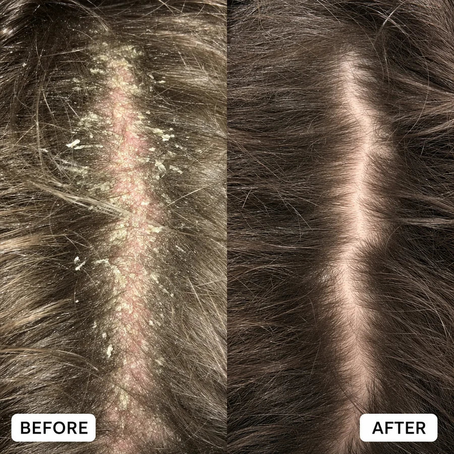 Scalp before and after: heavy flaking, then clear